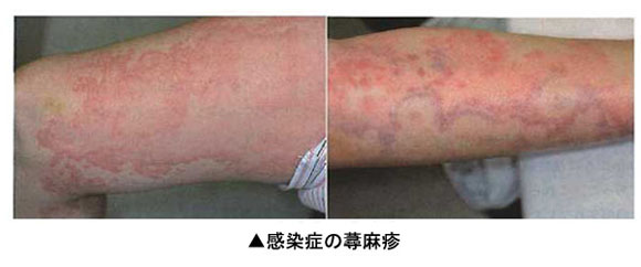 ウイルス性発疹症・水前寺皮フ科医院熊本市の皮膚科・形成外科・アレルギー科