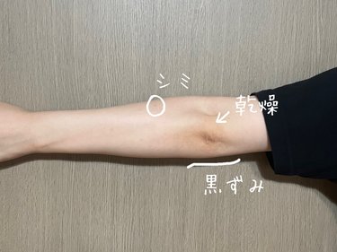 肘の黒ずみ 色素沈着 も綺麗になります💓目黒駅前アキクリニック