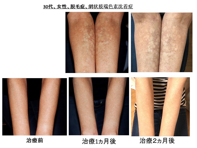 当クリニックの治療で、難病である網状肢端色素沈着症が改善！ 患者様からの声・メディア掲載・クリニックからのお知らせ名古屋Kクリニック