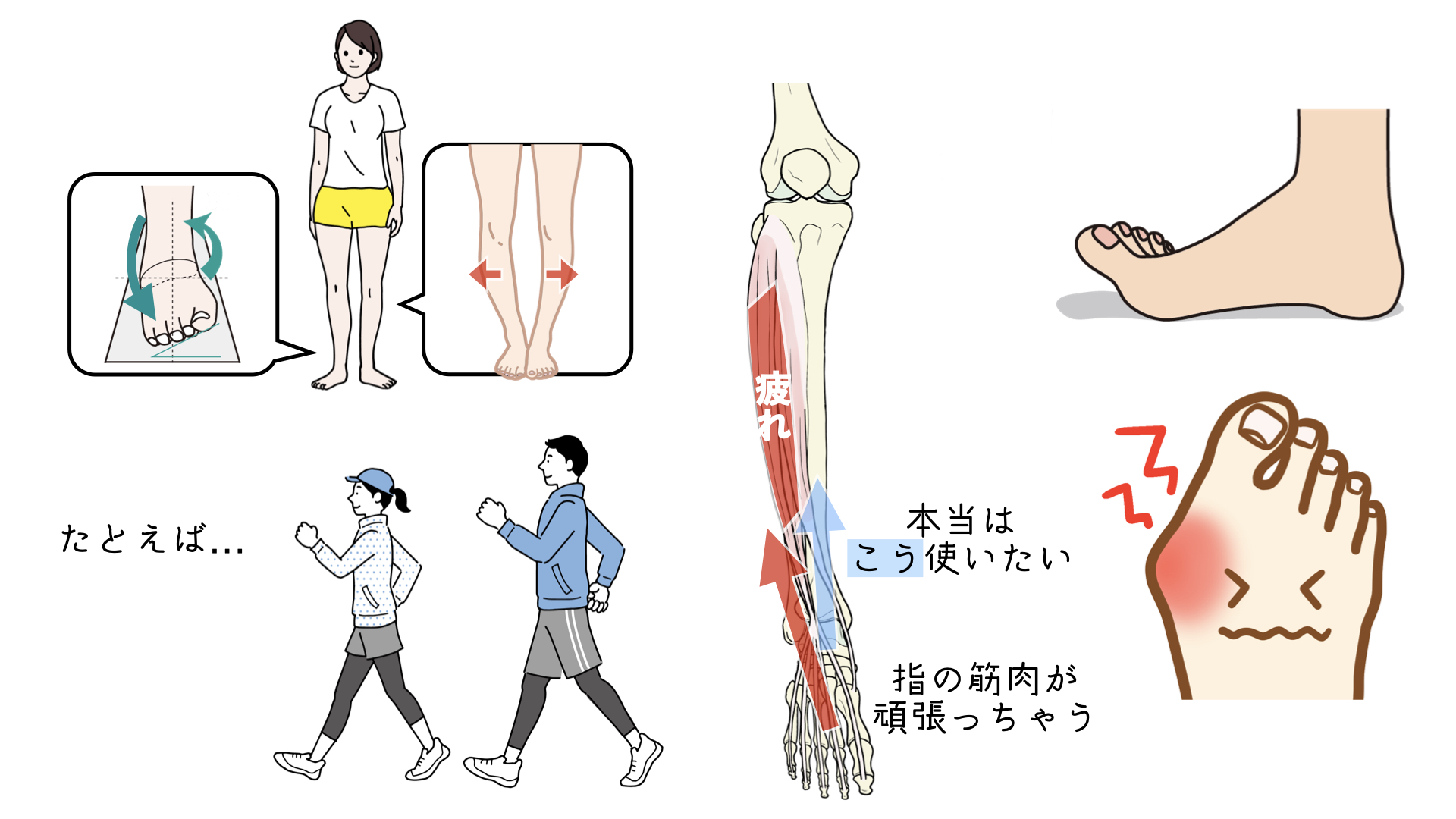 シンスプリント - 25. 外傷と中毒 - MSDマニュアル家庭版
