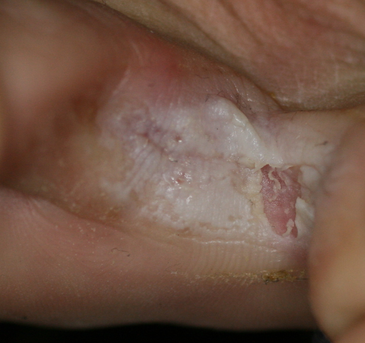 Amazon第3類医薬品公式雪の元A15g×2雪の元本店 ワセリン 軟膏 かゆみ止め 子供 非ステロイド 乳幼児 薬 湿疹皮膚炎 湿疹 しっしん 乾燥肌 敏感肌 かゆみ 痒み しもやけ あせも 塗り薬雪の元しっしん・かゆみ