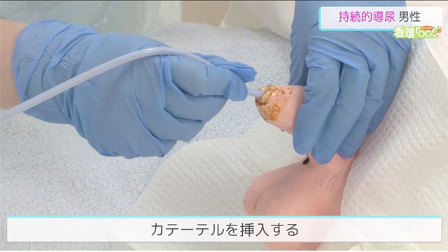 蓄尿バッグに尿がたまっていない場合 訪問看護のアセスメント- NsPace ナースペース -家で「看る」あなたを支える