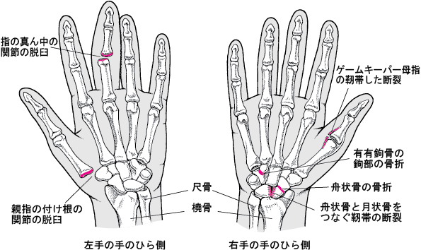 突き指じゃなくて骨折してるかも？ 突き指が治らない・曲げにくいのは他の症状が隠れている場合もふくだ整形外科益城町の整形外科熊本市東区隣接