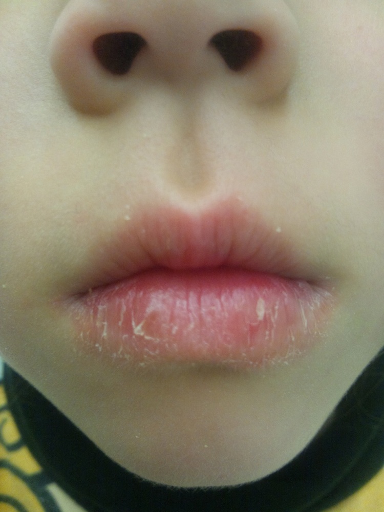 口角炎はカンジダ カビ 菌が原因！ 症状・治療法・予防法は？ケン歯科クリニック