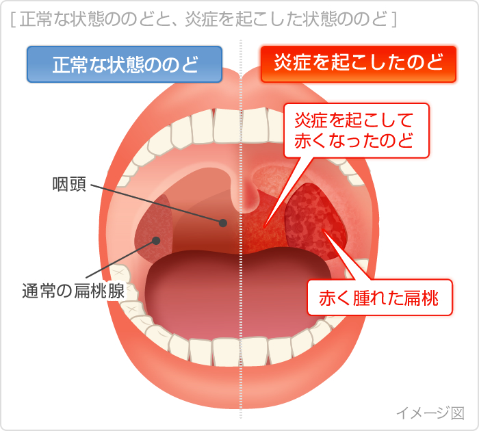 風邪 かぜ の症状・原因くすりと健康の情報局