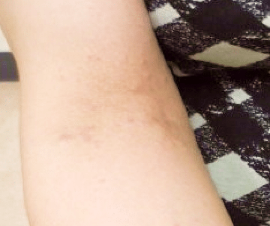 こどもの肌トラブル あせも・おむつかぶれ・虫刺され 曙橋駅徒歩3分、曙橋よつばファミリークリニック新宿区四谷三丁目、牛込柳町駅の小児科