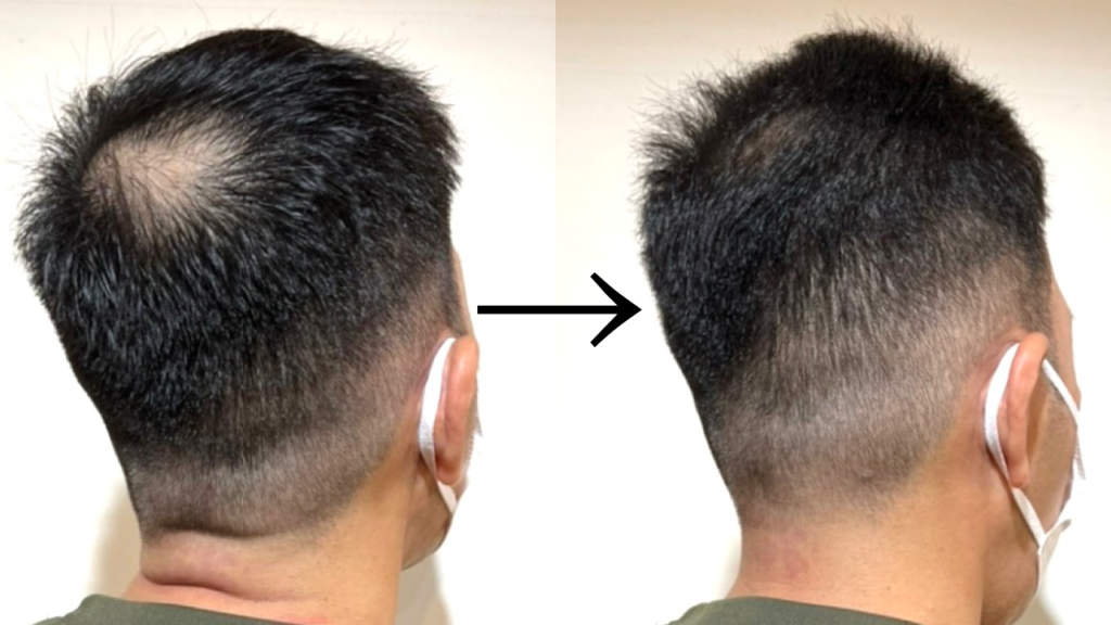 薄毛 ハゲ のメンズに似合うおすすめの髪型9選！頭頂部の薄毛やM字を隠す髪型も紹介