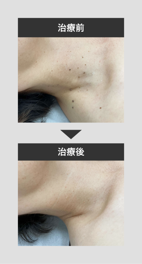 イボ・ホクロ・血管治療肌のクリニック 高円寺院 麹町院