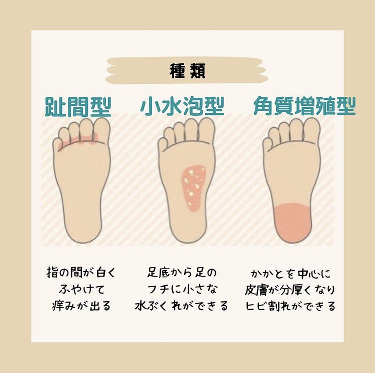 大阪・福島区で掌蹠膿疱症の治療は『野田阪神駅前いまい皮フ科小児皮フ科アレルギー科』