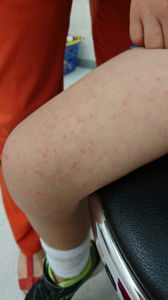 ホームメイト 赤ちゃんのあせも予防と治し方