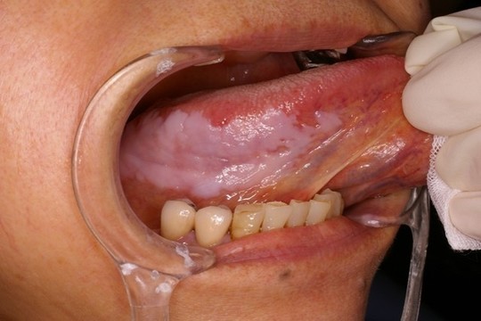 水ぶくれ？口内炎？OFFICIAL BLOG