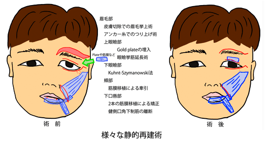 脳梗塞・片麻痺後の顔面麻痺 自主トレ・リハビリ⑥ 表情筋 言語聴覚 自費
