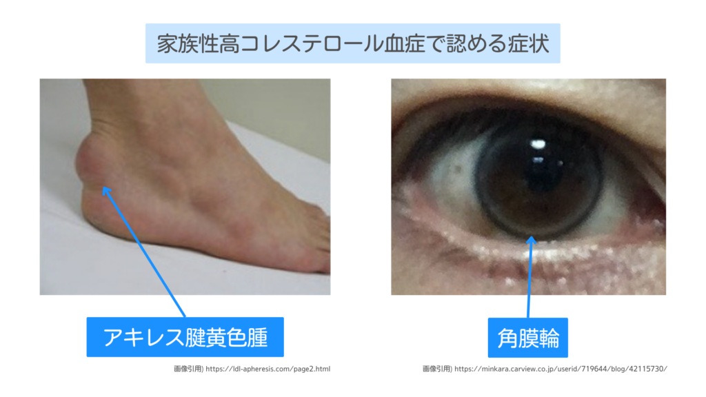 医師向け：家族性高コレステロール血症 FH について 日本動脈硬化学会