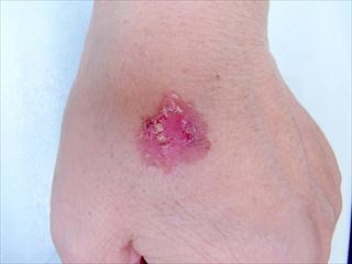 手足のほくろとほくろのがん 癌- 白崎医院