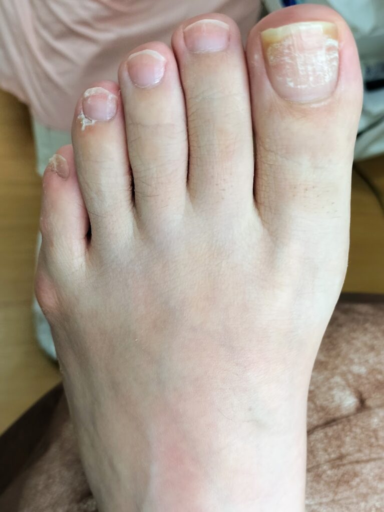 65歳以上の4割以上が爪の水虫「爪白癬」に？「巻き爪」「陥入爪」「肥厚爪」シニア世代に多い足の爪のトラブル 原因と対処法婦人公論.jp-Yahoo!ニュース