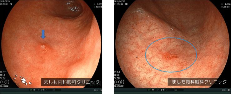 上部消化管 胃バリウム について.健診会 東京メディカルクリニック・人間ドック,東京都 北区
