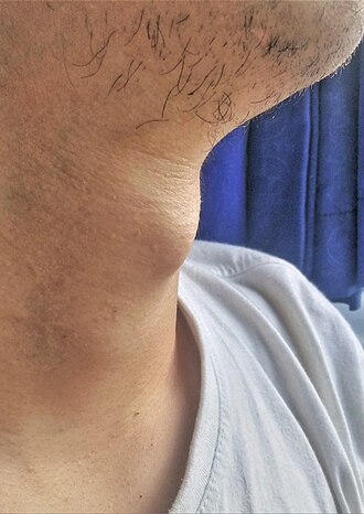 3.咽頭・喉頭 頭頚部病理診断教育支援