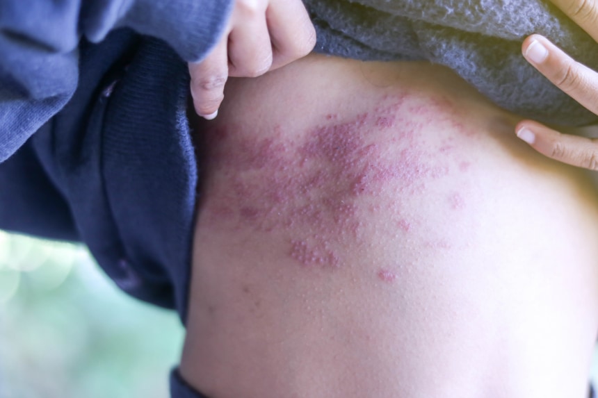 帯状疱疹写真で見る「子どもの病気」 - みやけ内科・循環器科 総合内科のアプローチ