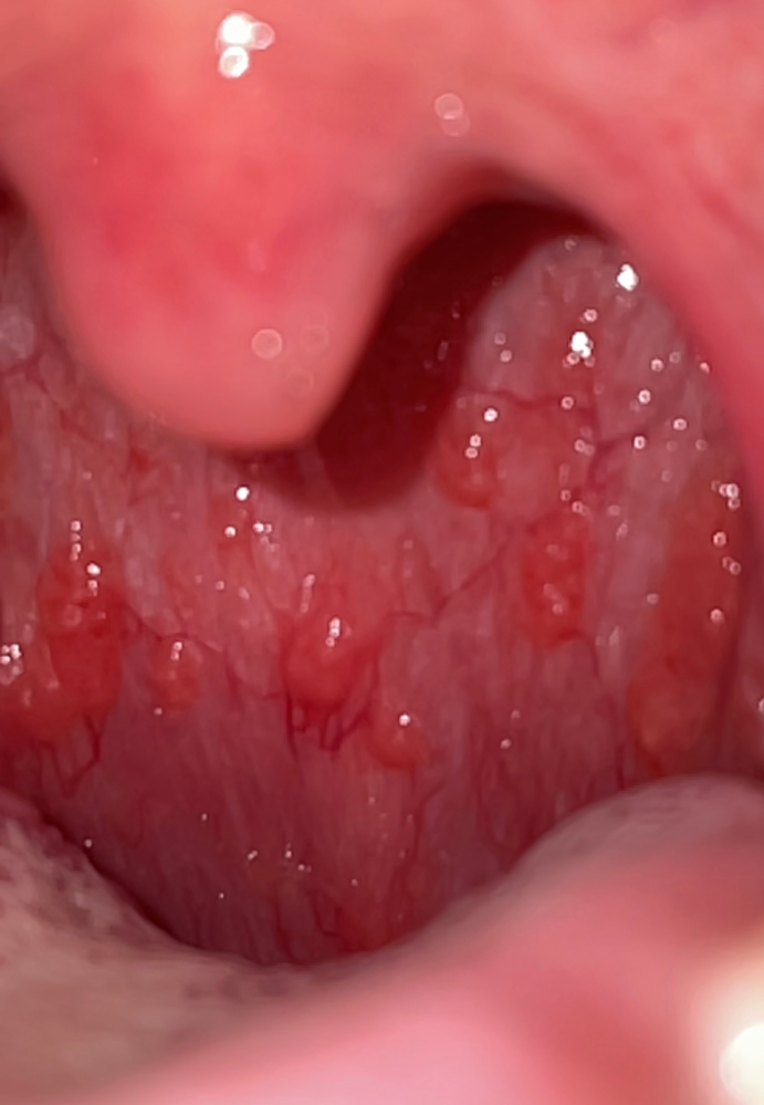 インフルエンザはのどで分かる！お役に立てるかも院長ブログあいＤｅｎｔａｌ・Ｍｅｄｉｃａｌ Ｃｌｉｎｉｃ