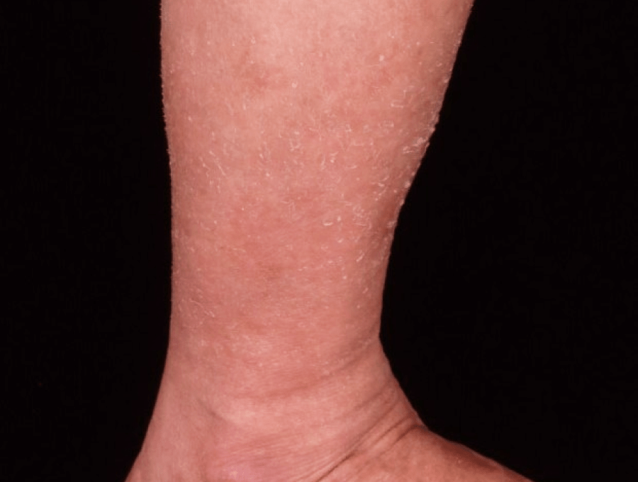 息子は生まれてきてすぐピエロと呼ばれた｡皮膚の難病｢道化師様魚鱗癬｣を抱える息子とともに生きる 体験談・医師監修 たまひよ