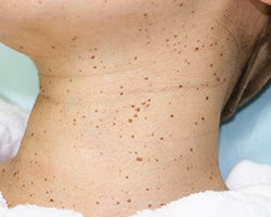 首イボ三つ子＋1と毎日