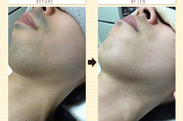 医療従事者監修 医療脱毛の効果とは？エステ脱毛との違いや施術回数・値段について医療脱毛、医療レーザー脱毛なら渋谷美容外科クリニック