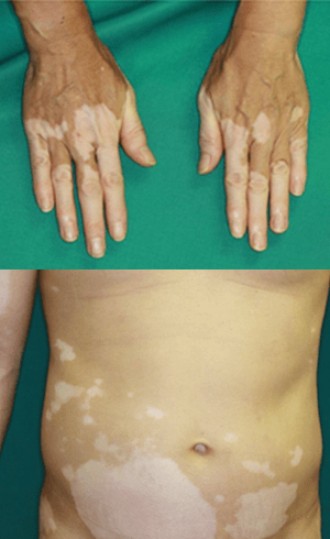 皮膚が白く抜ける！？ しろなまず『白斑』あつた皮ふ科・美容皮膚科クリニック名古屋市中川区の皮ふ科・美容皮膚科
