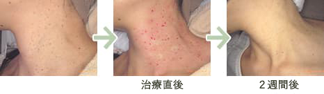 首イボはなぜできる？原因と治療法を医師が解説 - 首イボDr