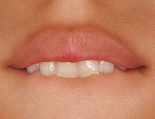 下唇を噛む癖は放っておいてもよい？クローバー歯科豊中駅前院 よくあるご質問