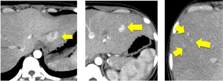 超音波検査で脂肪肝を，みて，見て，診よう 4