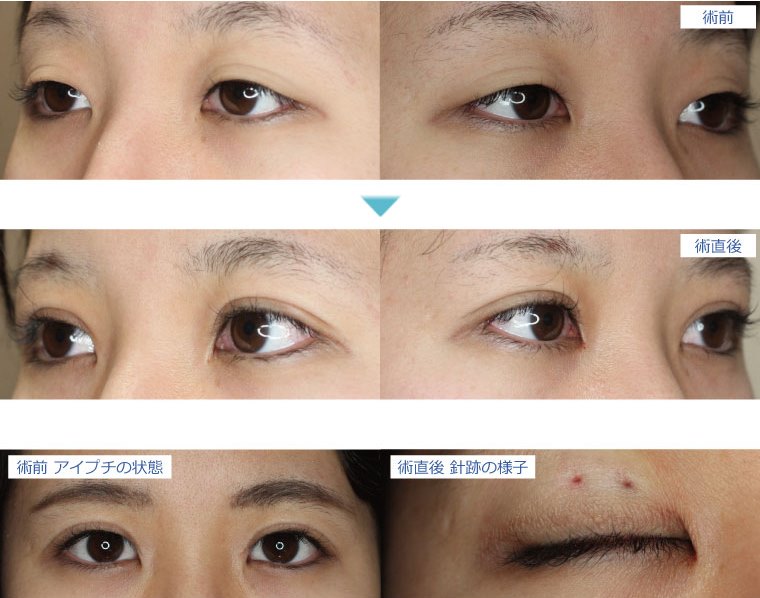長い間アイテープ アイプチ を使用してかぶれてしまっている方の二重まぶた埋没法日本美容外科学会認定専門医Dr石原信浩のブログ～いろんなオペやっています～ タウン形成外科クリニック