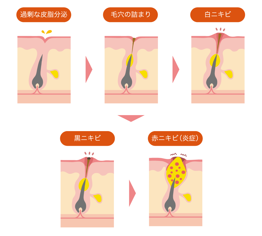 頭ニキビの治し方痛くても、潰してはげる前に試すべき治療方法