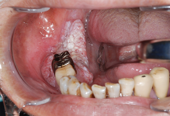 口腔内できもの治療例-松ヶ丘歯科口腔外科医院