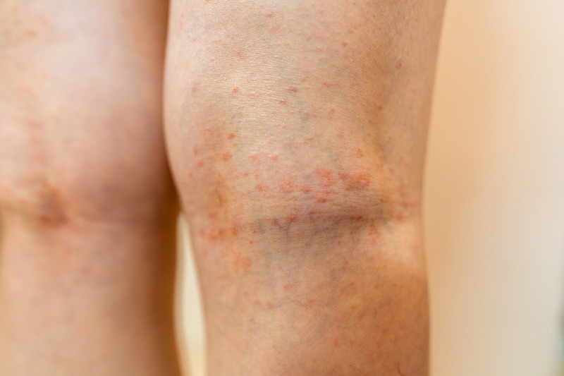 湿疹の原因と症状・治療湿疹にもさまざまな種類がある！？吹田市・江坂のたまき皮フ科