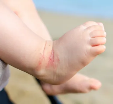 子どもの皮膚のブツブツ 湿疹 小児皮膚疾患こむらこどもクリニック