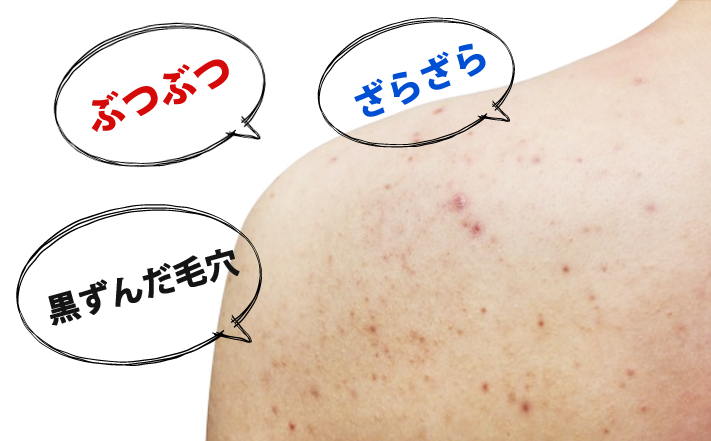 脱毛すると毛穴は消える？赤みやブツブツの対処法も解説 - ゴリラの医療脱毛コラム