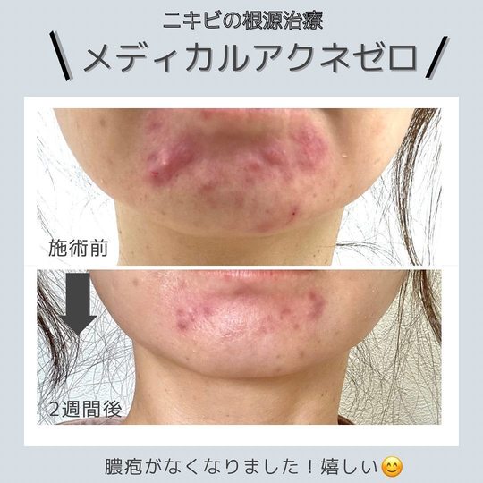 膿がたまったニキビの原因と対処ニキビ一緒に治そうProject製薬会社のマルホ