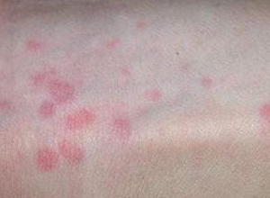 子どものアトピー性皮膚炎の皮膚の特徴乳児期、幼児・学童期、思春期・成人期小児皮膚疾患 さくら皮フ科 蒲郡市