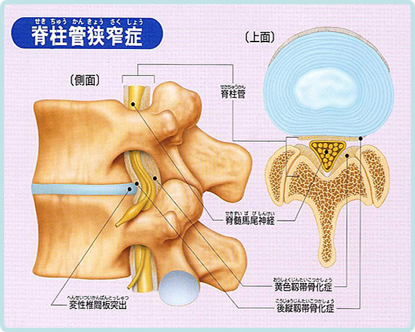 脳神経外科 腰部脊柱管狭窄症中京病院地域医療機能推進機構