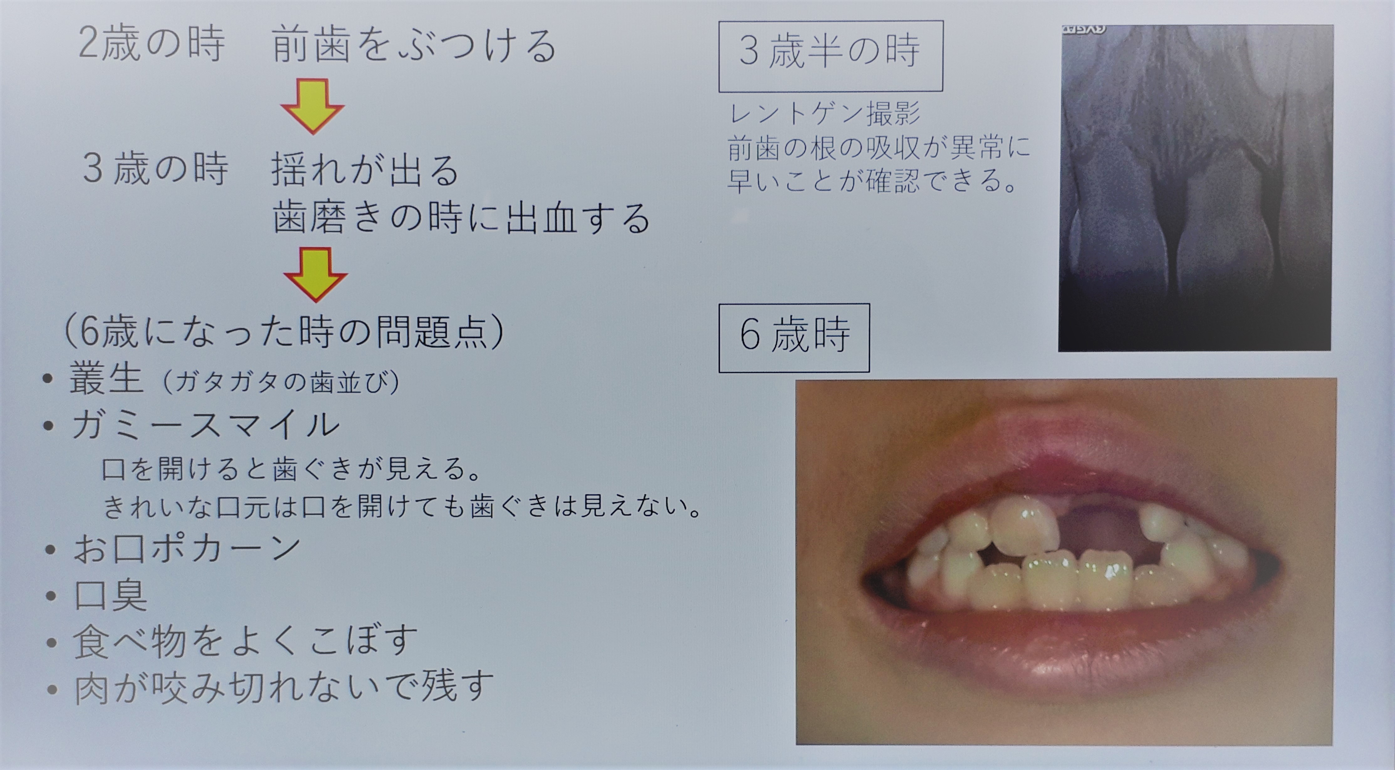 乳歯の早期脱落チェック 沼津市、難病の可能性見逃さず47NEWS よんななニュース