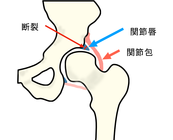 股関節に痛みが原因と考えられる疾患、対処法を整形外科医が解説
