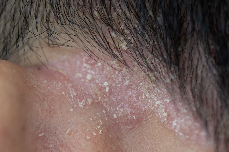 脂漏性皮膚炎あつた皮ふ科・美容皮膚科クリニック名古屋市中川区の皮ふ科・美容皮膚科