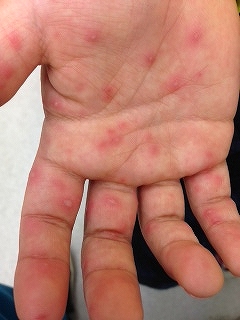 その手荒れ、「手湿疹」かも！？こまめな保湿対策でしっとりスベスベに知っておきたい病気・医療からだケアナビ