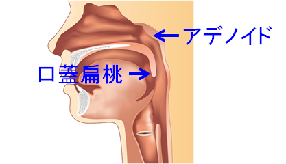 扁桃腺が痛くなる原因ハレナース・ハレナーススプレー小林製薬