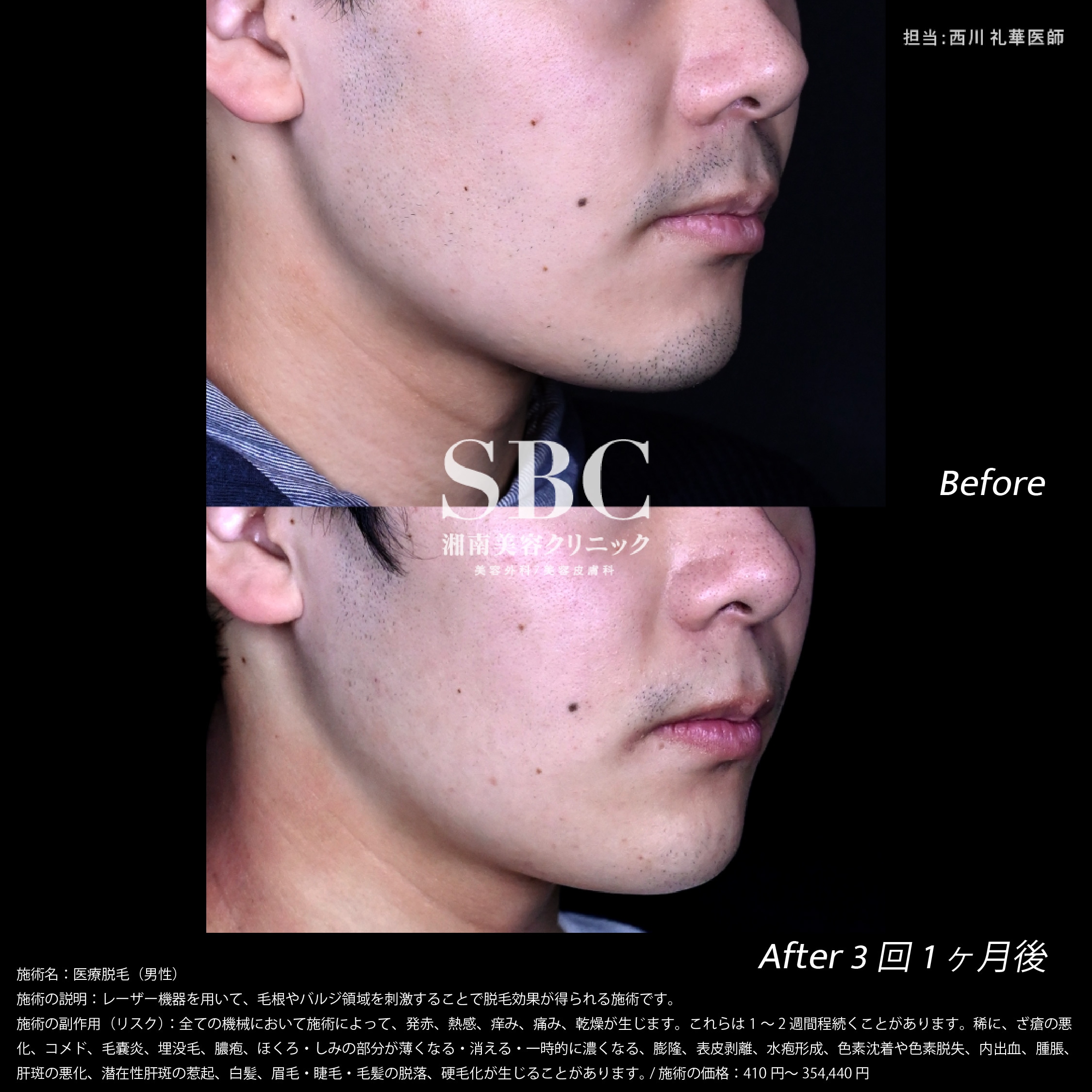 メンズ髭脱毛ブログ小田原の脱毛ならHair removal salon SORA