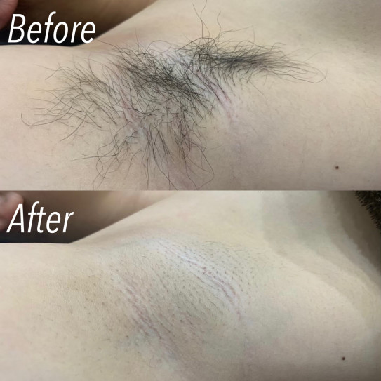 ビューティー 脇毛の脱毛処理後イメージ 虫眼鏡を持つ 脱毛サロン 写真素材4974210- フォトライブラリ