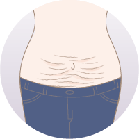 症状と原因 産後のお腹のたるみマミーメイクオーバ