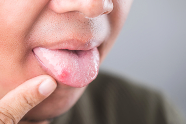 口内炎は放置しても問題ない？危険な口内炎の症状や放置リスクについて