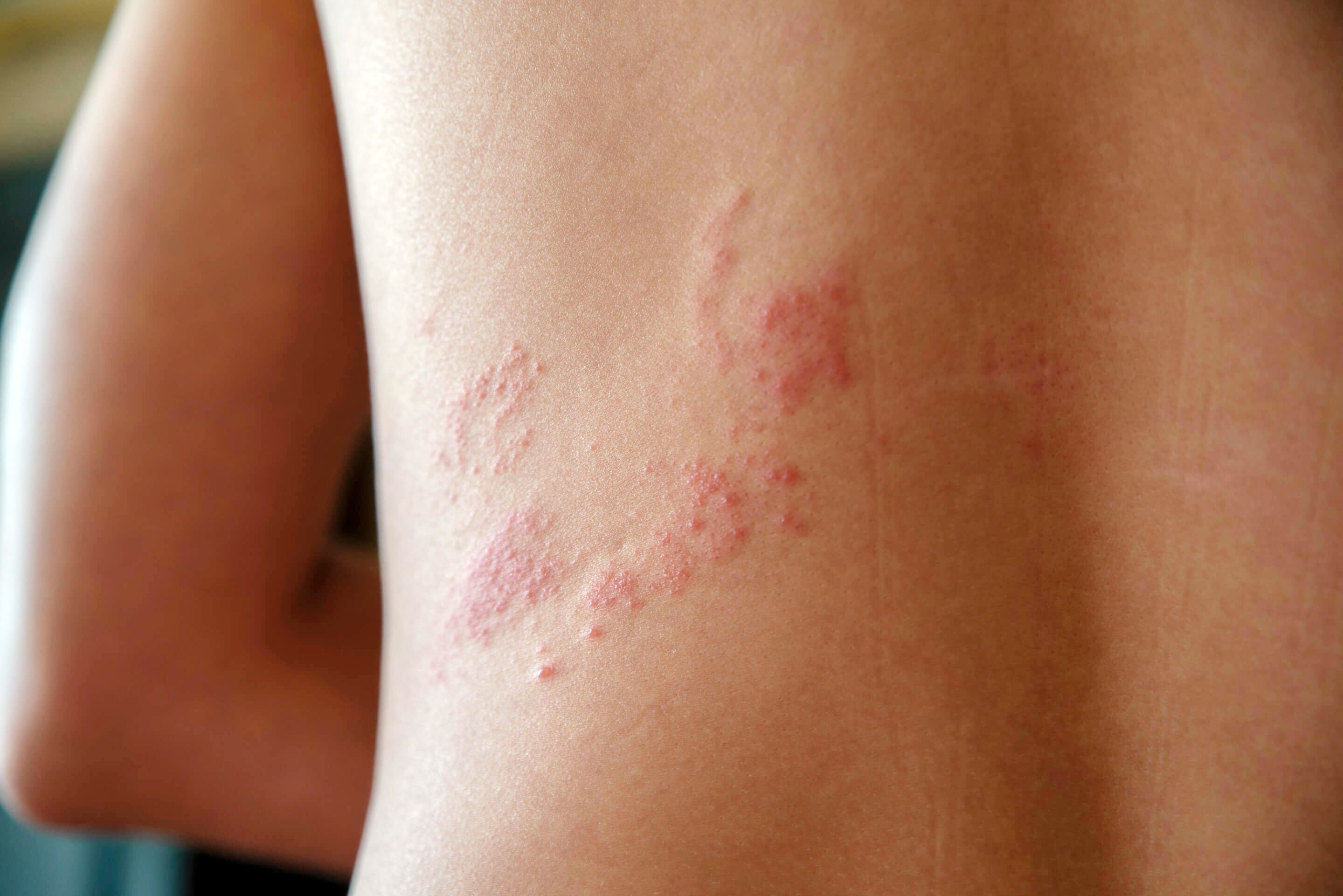 帯状疱疹はうつる？ 初期に現れる症状とワクチン接種で予防する大切さメディカルドック