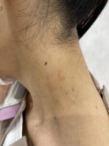 首イボ治療から１週間が経過しました - 東京 渋谷 美容皮膚科 マグノリア皮膚科クリニック